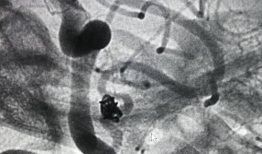 造影视频全过程,揭示血管奥秘与诊疗过程